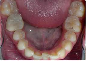 retainers retention orthodontic types teeth braces after